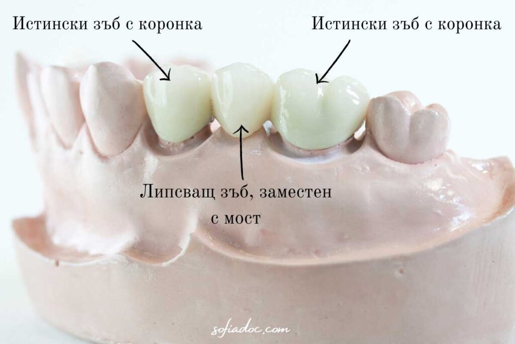 зъбен мост