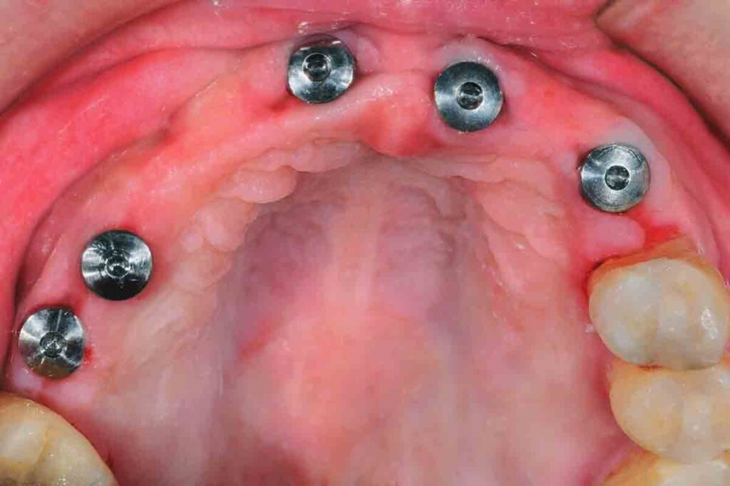 зъбни импланти